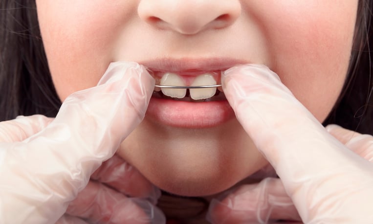 An orthodontist wearing disposable gloves places an orthodontic appliance for children on a young girl